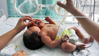 Умря китайското момиченце с две глави
