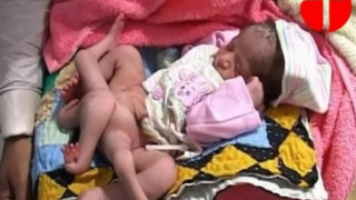 Наша болница готова да оперира бебе с 6 крачета