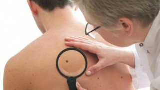 Безплатни прегледи за рак на кожата в столицата