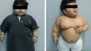 Оперираха 2-годишно дете, което тежи 33 кг.