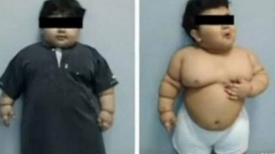 Оперираха 2-годишно дете, което тежи 33 кг. | StandartNews.com