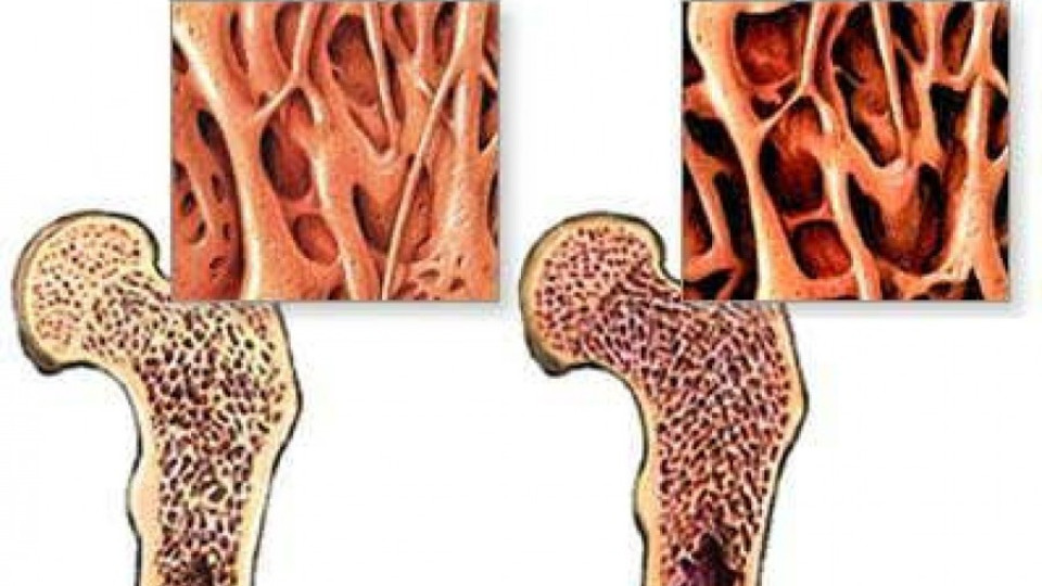 Oтбелязват Световния ден за борба с остеопорозата | StandartNews.com