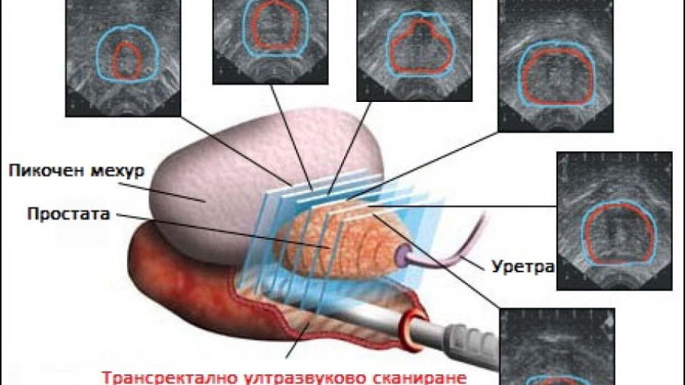 Три ключови ползи от лазерната хирургия на простатата с Тулиум 200 вата | StandartNews.com