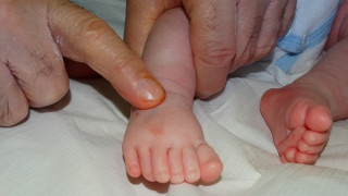 Оперерираха бебе с по 6 пръста  на ръцете и на краката