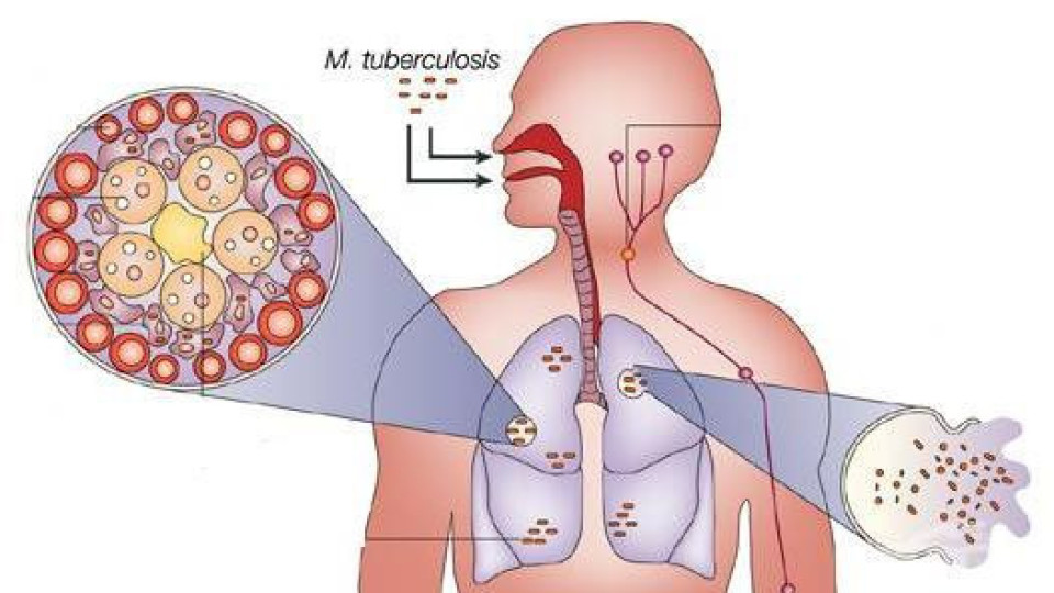 Коронавирусът връща туберкулозата | StandartNews.com