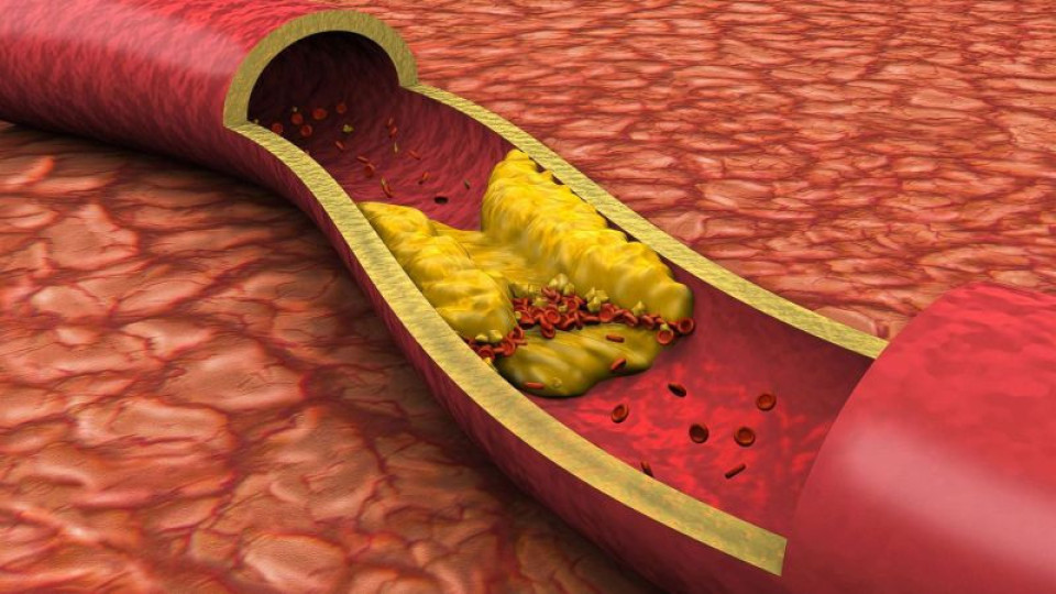 Тези 4 болежки издават висок холестерол | StandartNews.com