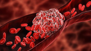 Учени откриха защо се образуват кръвни съсиреци