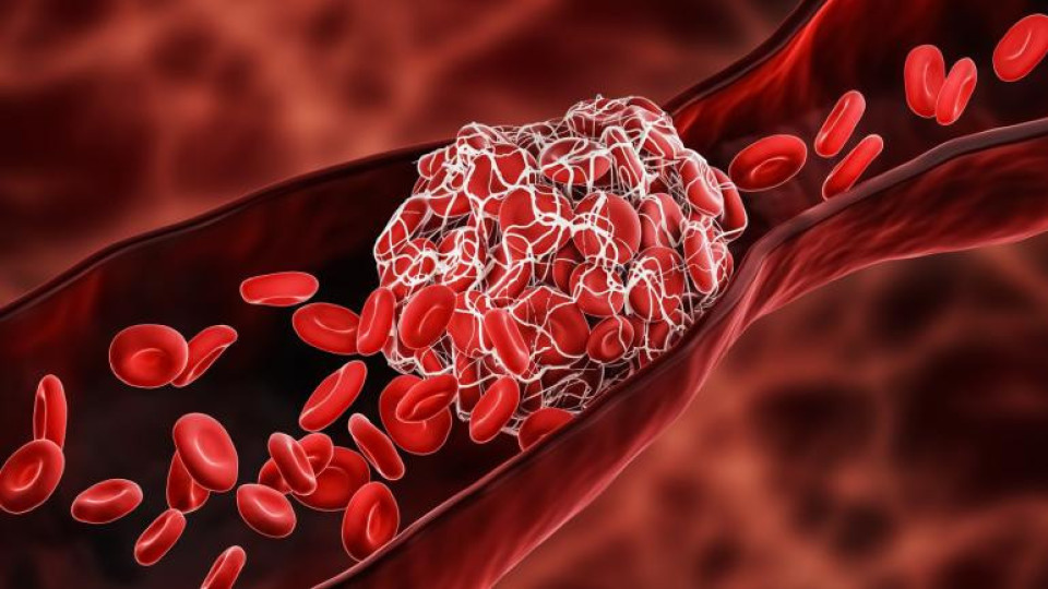 Учени откриха защо се образуват кръвни съсиреци | StandartNews.com