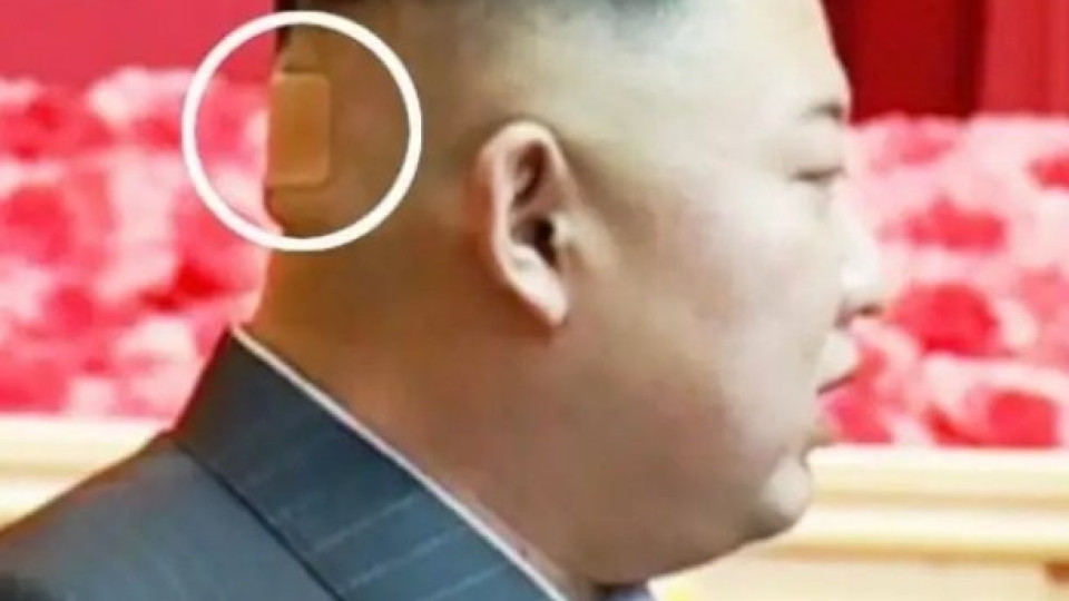 Догадки за раната на главата на Ким Чен Ун | StandartNews.com