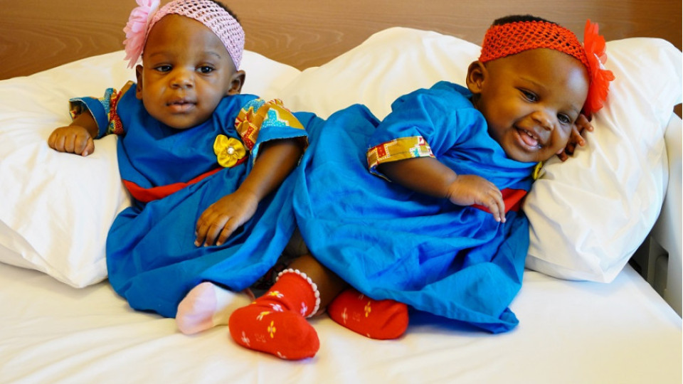 Разделиха сиамски близнаци. Уникална операция! | StandartNews.com
