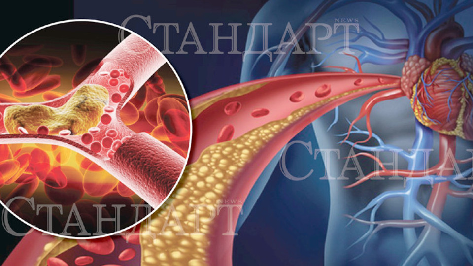 Този лош, лош холестерол...Какво да ядем, за да се предпазим? | StandartNews.com