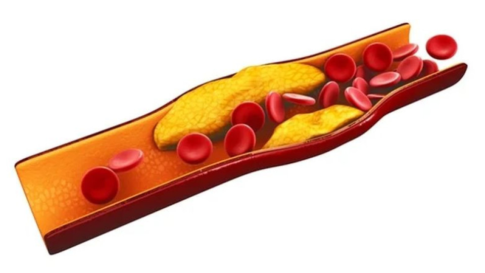 Лекарка даде 5 начина за справяне с лошия холестерол | StandartNews.com