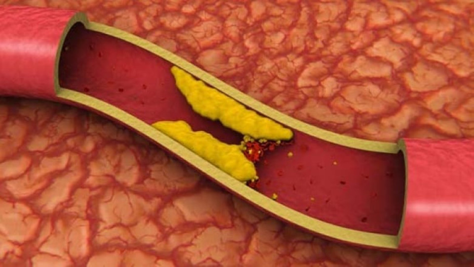 Три признака издават опасно висок холестерол | StandartNews.com